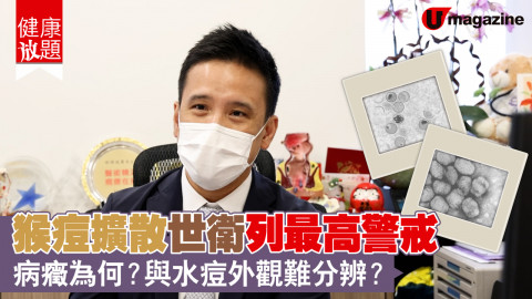 【健康放題】猴痘有機會傳入香港？